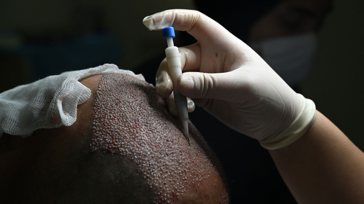 Hair Transplant Treatment in Mumbai at Mumbai Cosmetic Centre