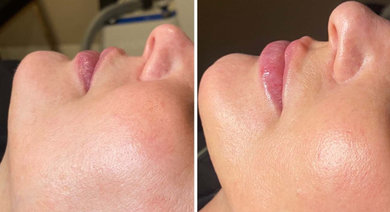 Hydrafacial treatment before-after results in mumbai at mumbai cosmetic centre