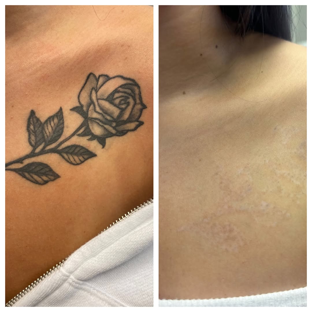 Laser Tattoo Removal in mumbai at mumbai cosmetic centre, Before After Result of Rose Tattoo removal