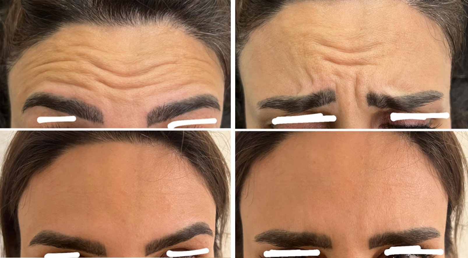 Botox Before and After - Crow's Feet results at mumbai cosmetic centre