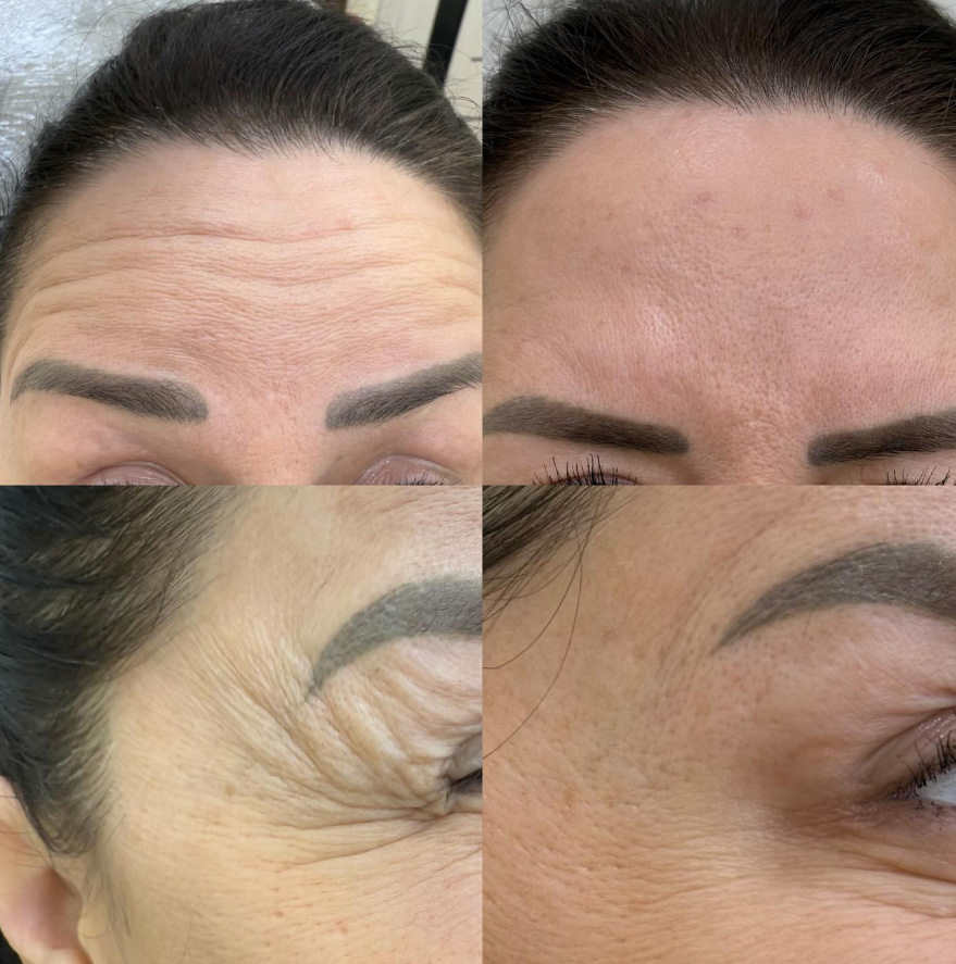 Botox Before and After - Forehead Lines results at mumbai cosmetic centre