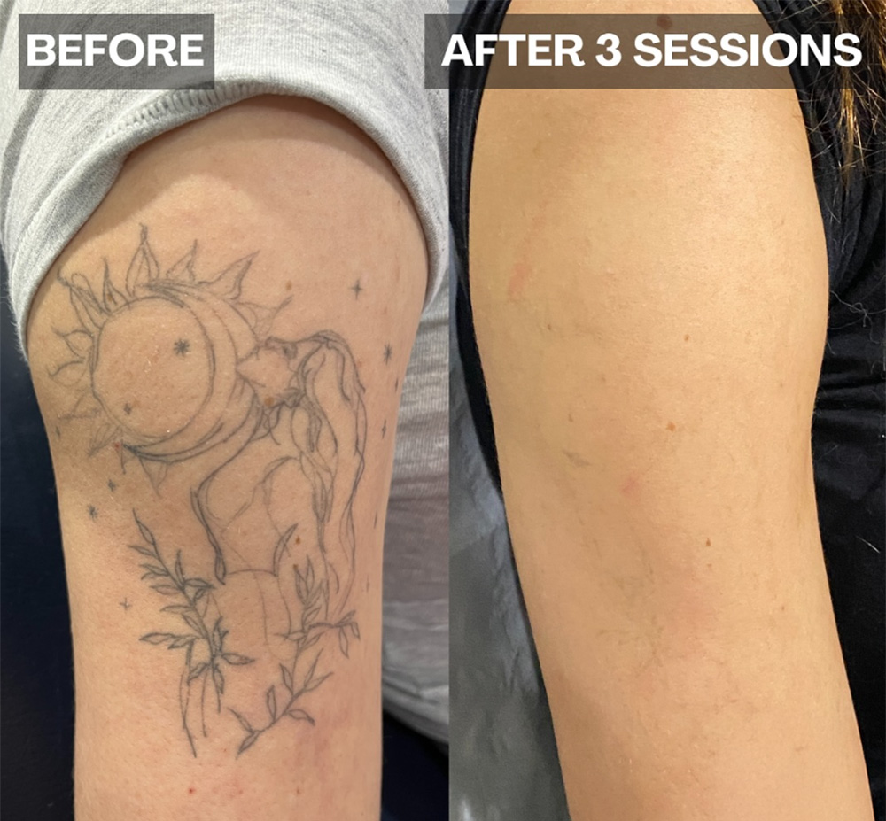Laser Tattoo Removal in mumbai at mumbai cosmetic centre, Before-After Result after 5 weeks