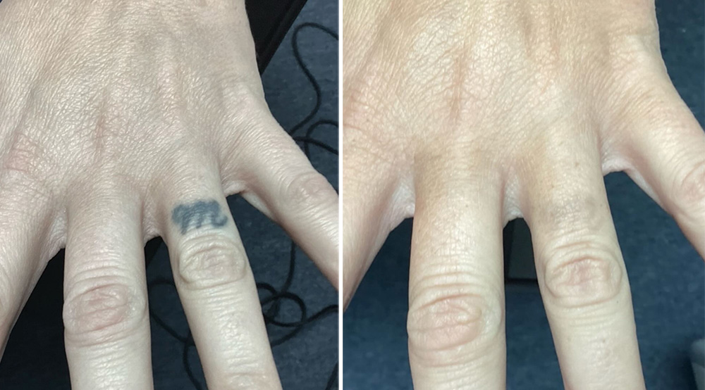 Laser Tattoo Removal in mumbai at mumbai cosmetic centre, Before After Result 6